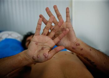 Alerta Epidemiológica en México por Viruela Símica: 49 Casos Confirmados, 7 en Quintana Roo