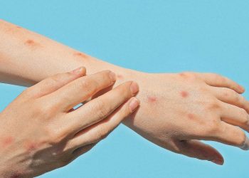 Nuevos casos de viruela símica en Quintana Roo: ¿Qué está ocurriendo?