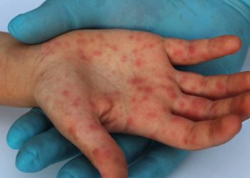 EE.UU. reporta contagio del nuevo tipo de viruela del mono en un viajero