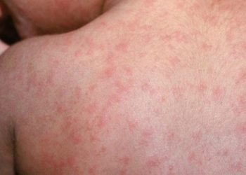 Muere de sarampión un niño no vacunado en Texas, en medio de brote