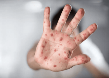 Muere niño no vacunado por brote de sarampión en Texas