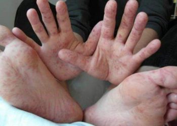 Posible brote del virus Coxsackie en guardería de Campeche; así afecta