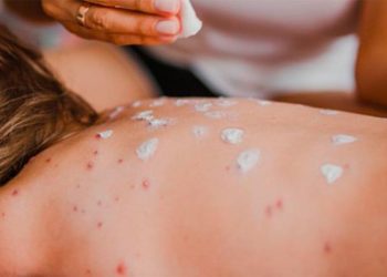 Texas reporta segunda muerte por sarampión; víctima no estaba vacunada