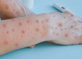 Muere paciente con viruela símica en Quintana Roo; es el primer caso fatal de 2025