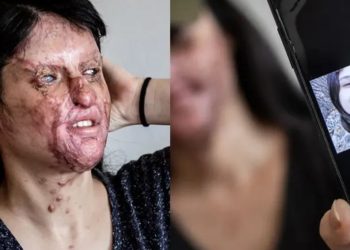 Matrimonio tras ataque con ácido desata polémica en Turquía