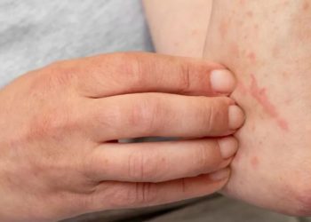 Alergia afecta a millones en México: 40% de la población la padece