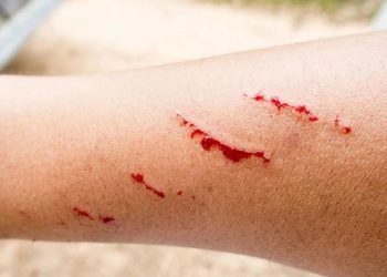 Alerta en Zacatecas, detectan primer caso de rabia humana en 40 años