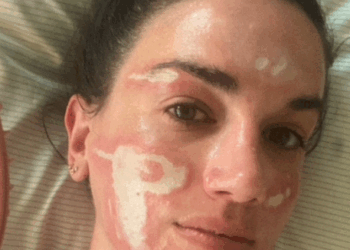 Denuncian a esteticista de Beverly Hills por «desfigurar» el rostro de una clienta