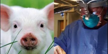 Trasplantes Avanza el Uso de Riñones de Cerdos en Humanos