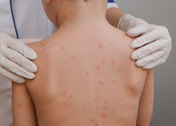 México en alerta máxima: el sarampión se extiende a los 32 estados del país