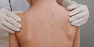 México en alerta máxima: el sarampión se extiende a los 32 estados del país