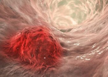 Cáncer colorrectal: preocupante aumento entre jóvenes de poco más de 20 años