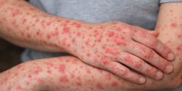 Brote de sarampión en México llega a 14 481 casos: transmisión activa en todo el país