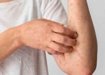 Alerta sanitaria en México: brote de sarampión supera los 12 mil casos y las autoridades intensifican respuesta