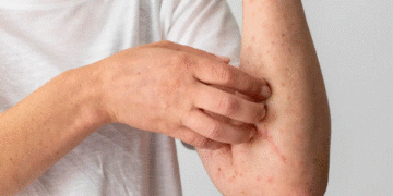 Alerta sanitaria en México: brote de sarampión supera los 12 mil casos y las autoridades intensifican respuesta