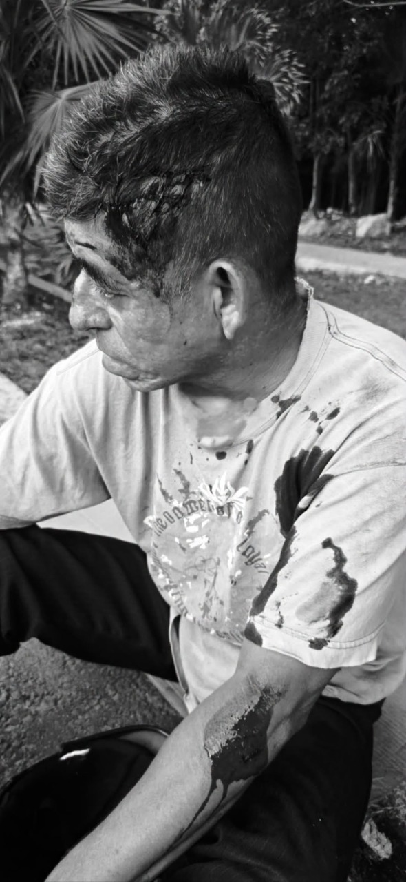Motociclista hospitalizado tras choque en avenida Kabah