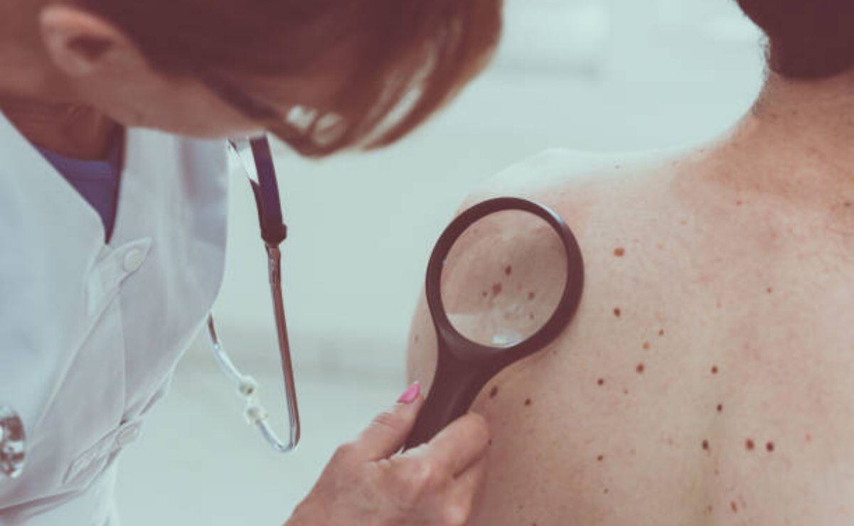 Merck y Moderna anuncian avance en vacuna contra melanoma
